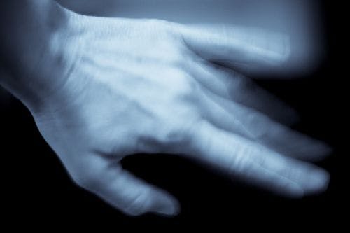Ultrasound May Provide More Precise Essential Tremor Treatment