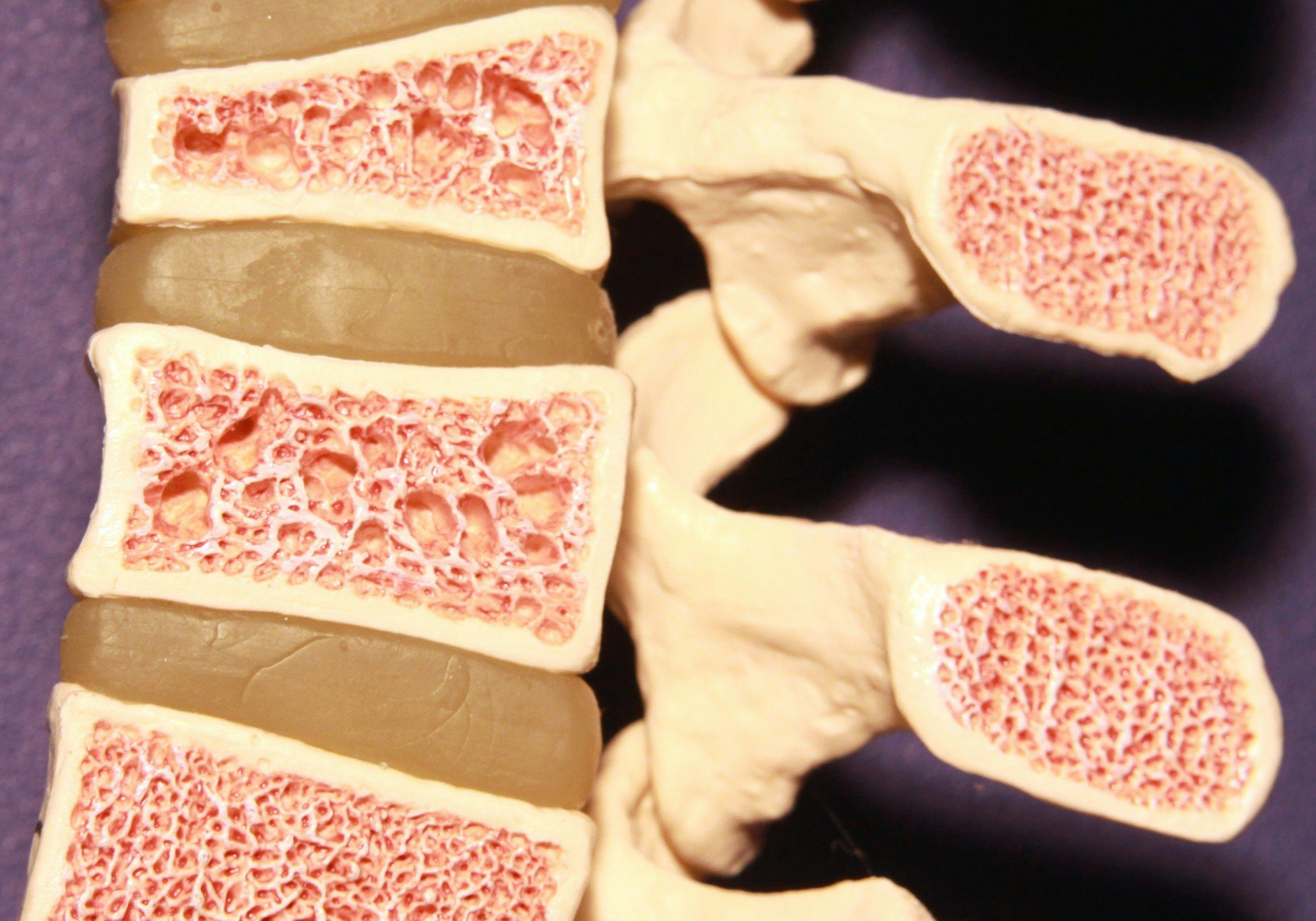 E Michael Lewiecki, MD: When is Osteopenia Osteoporosis?