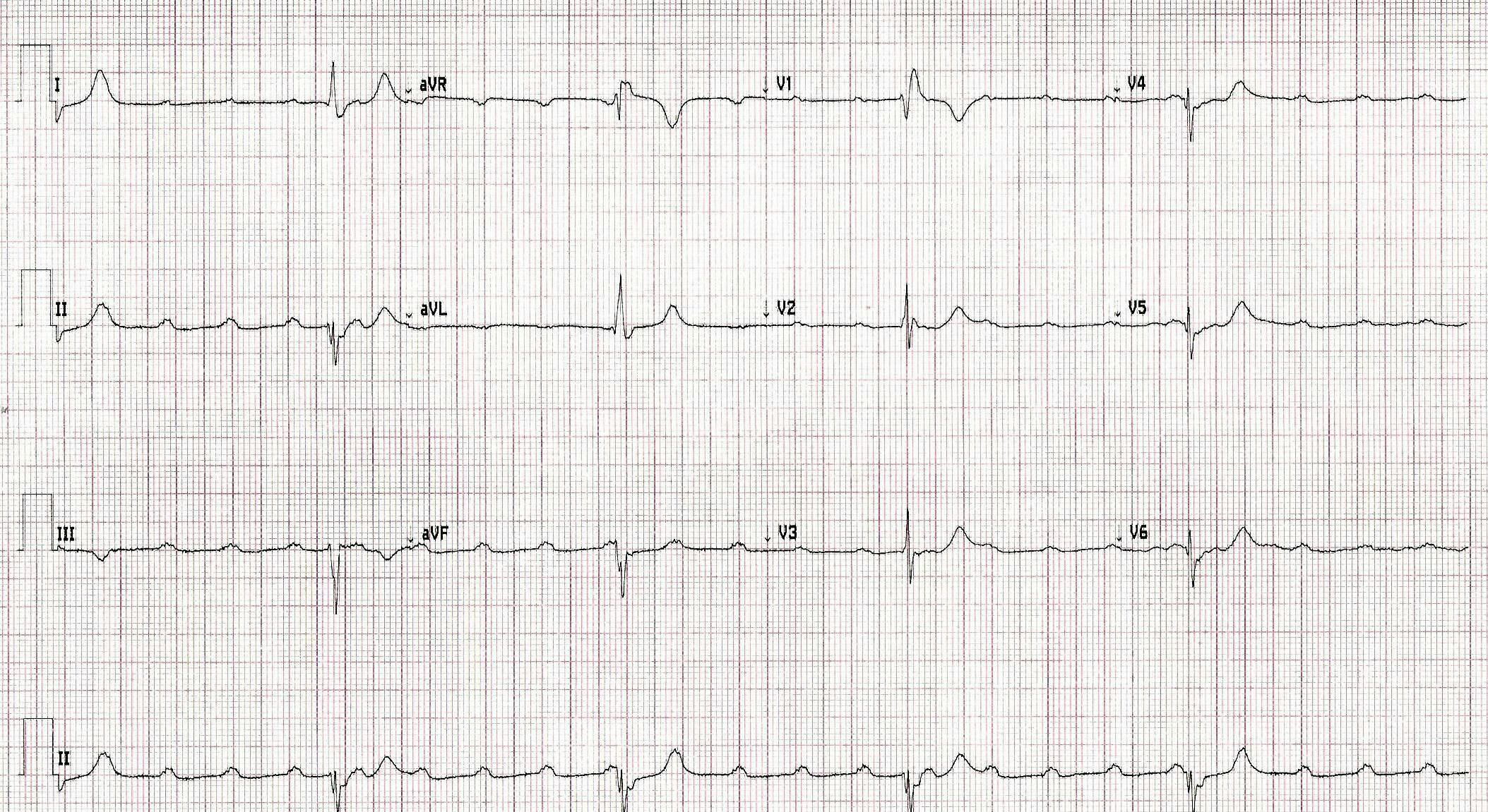 ECG print out from a patient experiencing chest pain