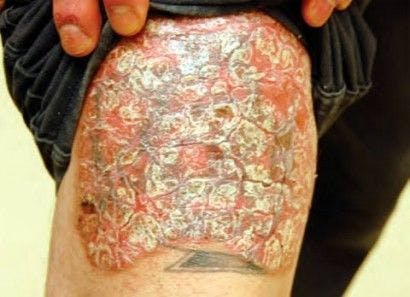 Plaque psoriasis. (Tanya Munger, MSN and Robert Bales, MD, MPH)