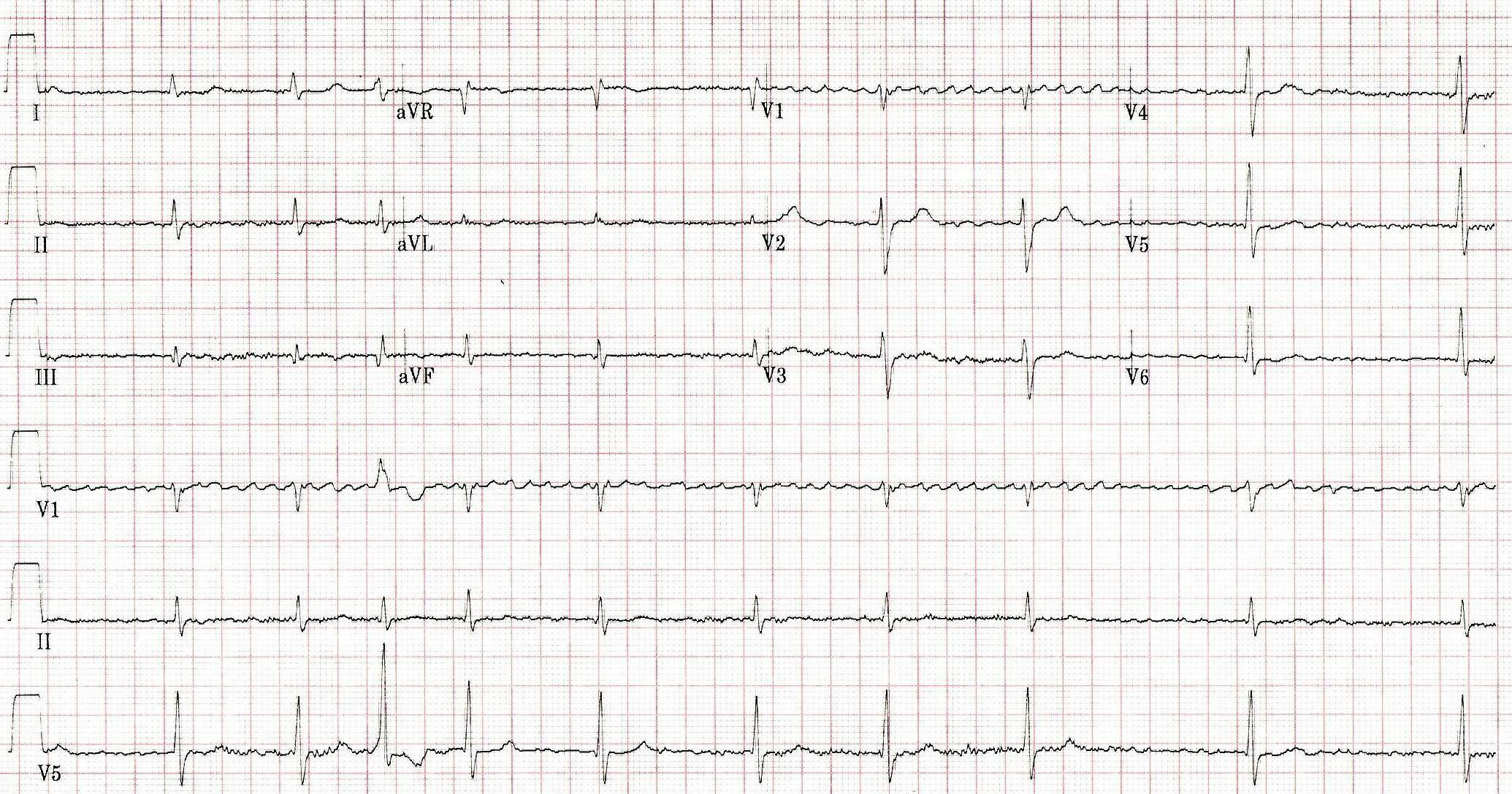 EKG strip of a patient with atrial fibrillation.