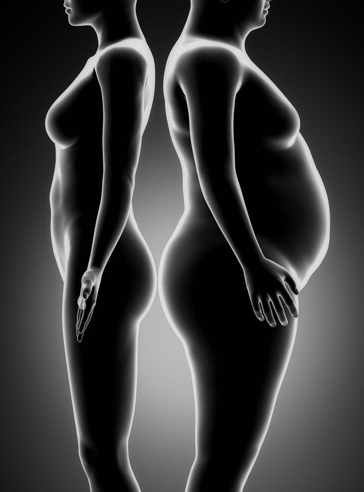 Weight Loss from Bariatric Surgery Reduces PsA Symptoms