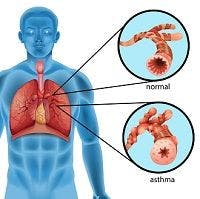 Wrangling Rogue â€œADAM33â€ Gene Could be Key to Preventing Asthma