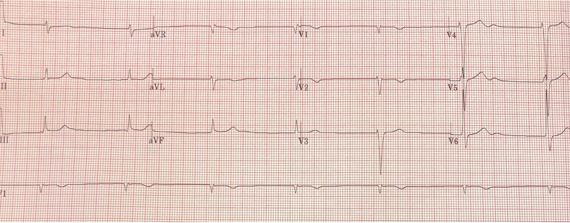 Case Report: Junctional Bradycardia in a 42-Year-Old Male