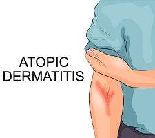 Breakthroughs in Atopic Eczema Treatment and Prevention Highlighted in Year-End Reviews