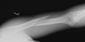 Young Women with RA Have Increased Risk of Broken Bones