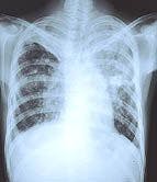 Use of Corticosteroids Potentially Linked to Tuberculosis