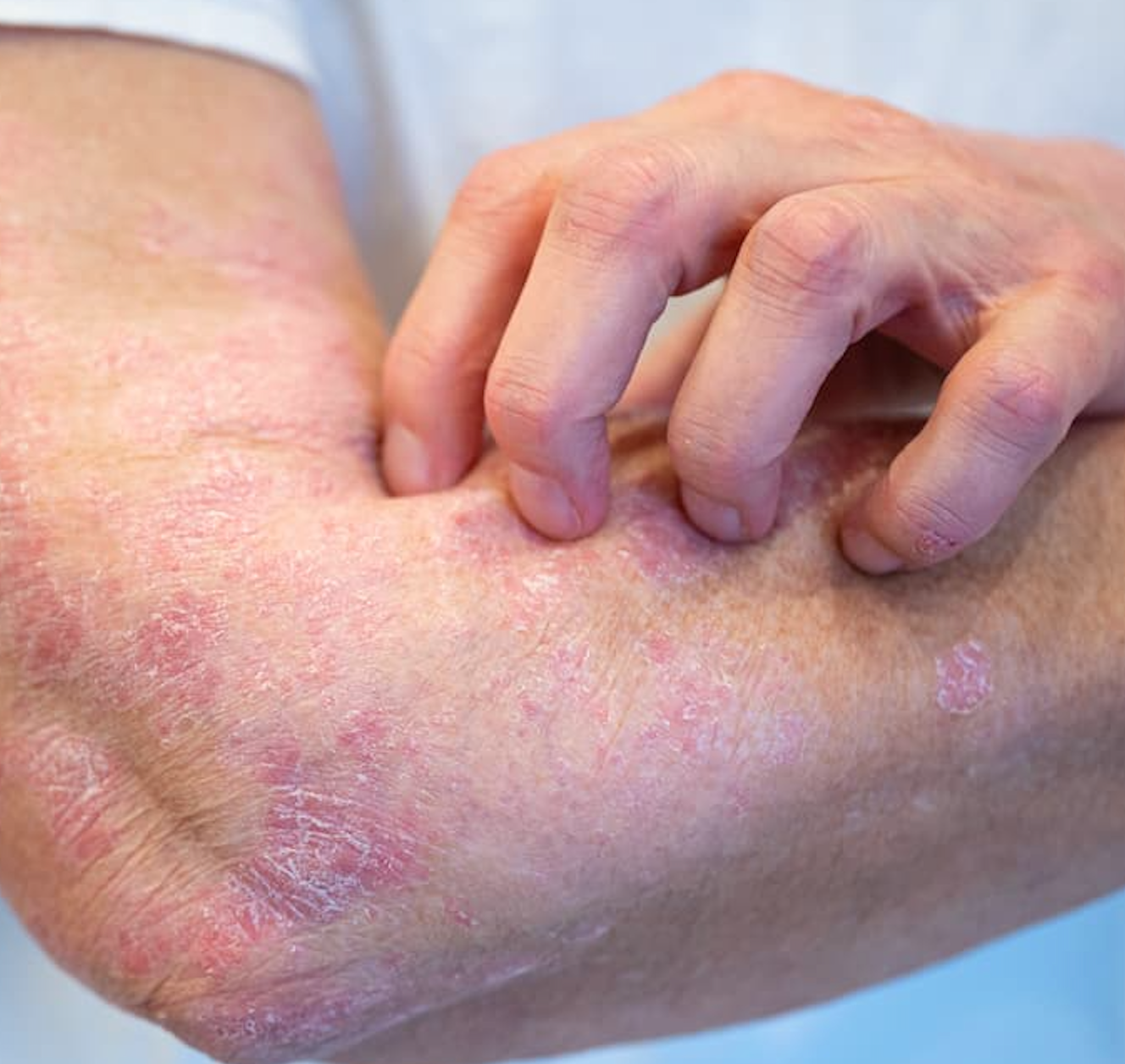 Higher Risk of Autoimmune Diseases Among Patients with Psoriatic Disease