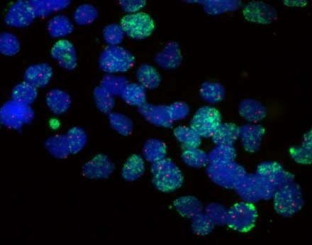 Reprogrammed Herpes Virus Blocks Neuroblastoma Stem Cells