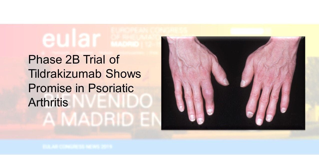 Tildrakizumab shows promise for psoriatic arthritis.