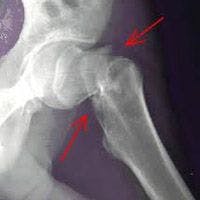 Previous Fractures Linked with Widespread Body Pain