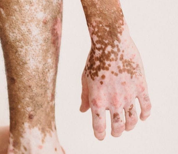 Study Suggests Topical 5-Fluorouracil Therapy Promising as Treatment for Vitiligo