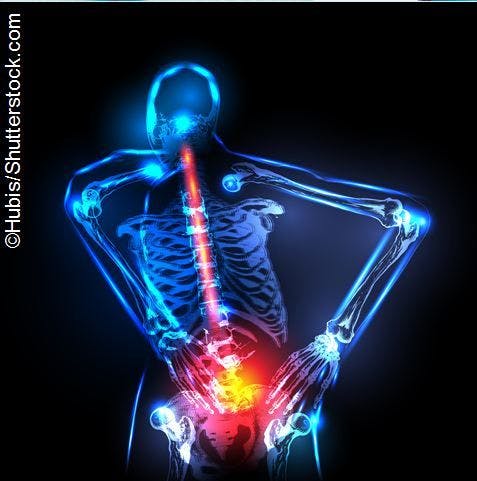 Low Bone Mass Linked to Radiographic Progression in axSpA