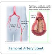 Tests of New Self-Expanding Stent for Use in the Superficial Femoral Artery Will Be the First "Harmonized Clinical Trial" in the US and Japan
