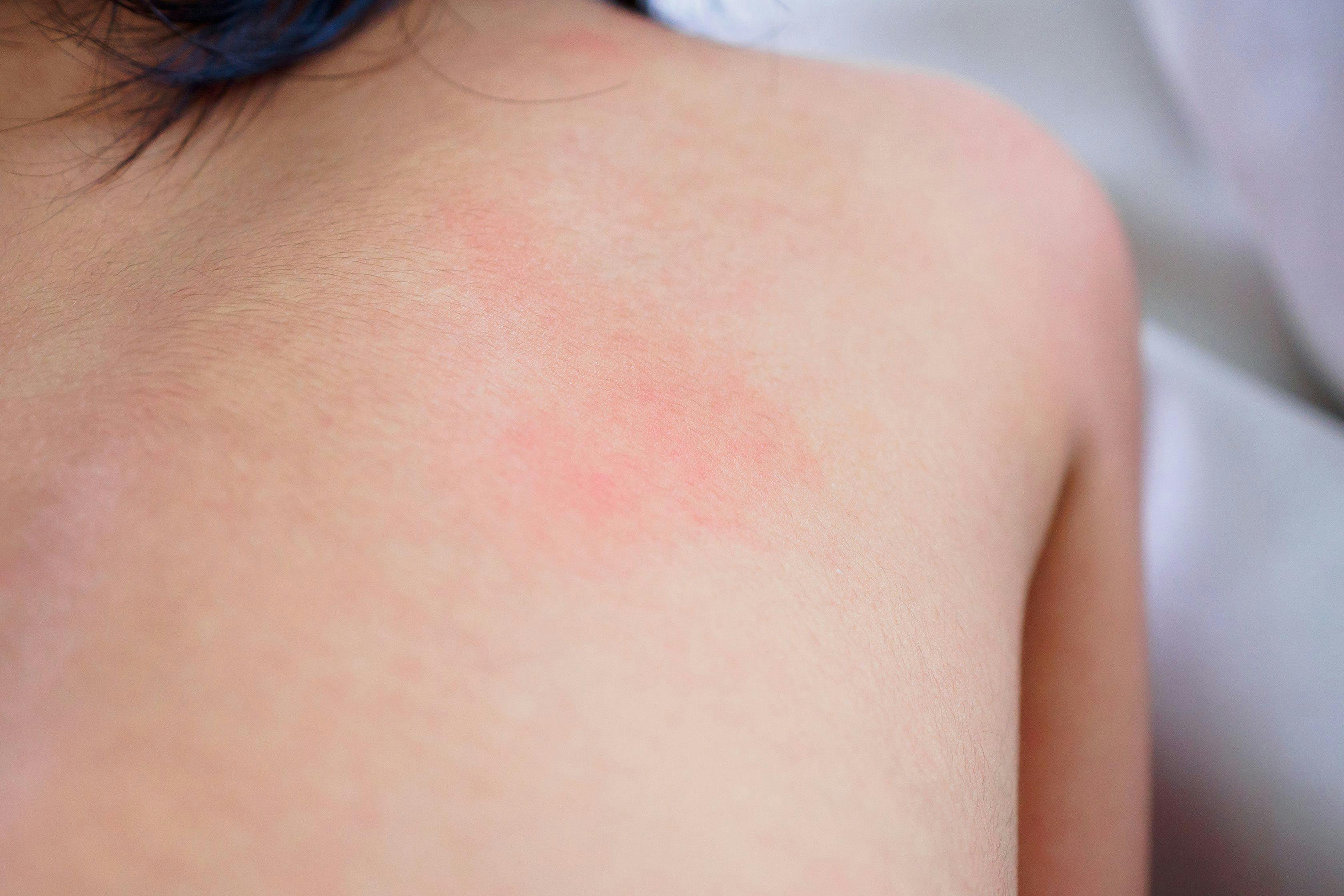 Psoriasis Risk Rises with TNF Inhibitor Use in Pediatric Inflammatory Diseases
