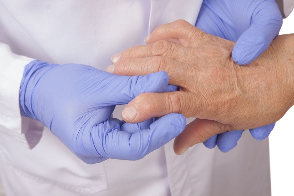Rheumatoid Arthritis Comorbidities: A 5-Question Quiz
