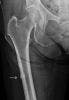 Study Links Long-term Use of Bisphosphonates to Unusual Fractures