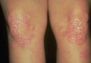 Despite Current Recommendations, Corticosteroids Are Widely Prescribed for Psoriasis