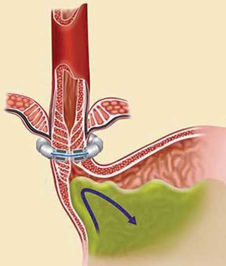 Esophageal Band Implant Reduces GERD Symptoms