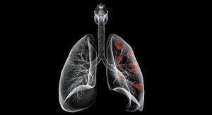 Lung Cancer Detection, Treatment Measures Featured in Report on Top Advances