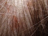 Sensitive Skin No Match for New Shampoo for Hair Transplant Patients