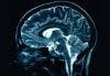 New Brain Scan Accurately Spots Autism