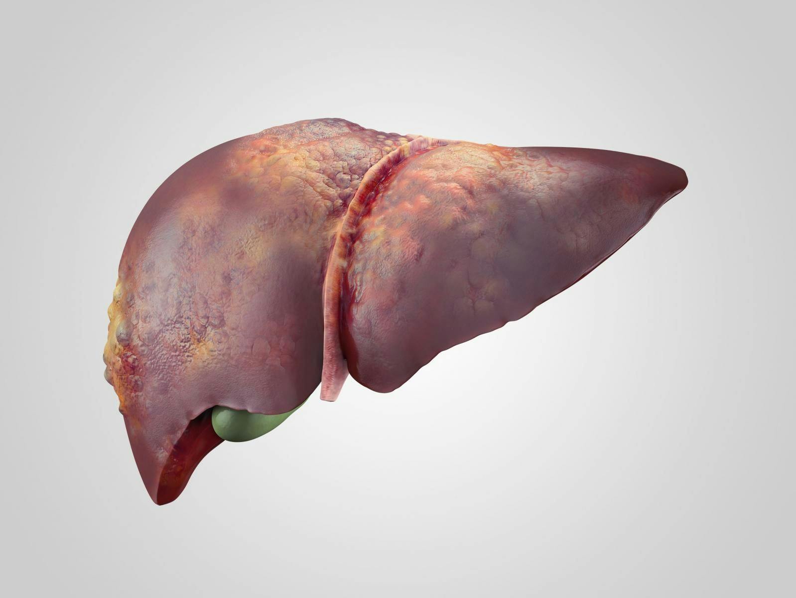 Phase 3 Results of Cabozantinib in Hepatocellular Carcinoma Released