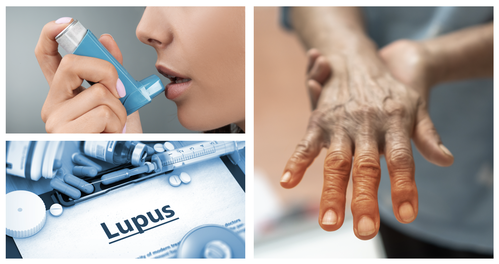 Asthma and COPD Linked to Worse Outcomes for Patients With Systemic Lupus Erythematosus 