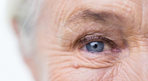 age-related macular degeneration, anti-vascular endothelial growth factor agents, exudative, intravitreal injection, neovascular, nutraceutical, nutritional supplement, omega-3 fatty acids, ophthalmology, stabilization, Resvega, retinal structure, transâ€“resveratrol, visual acuity