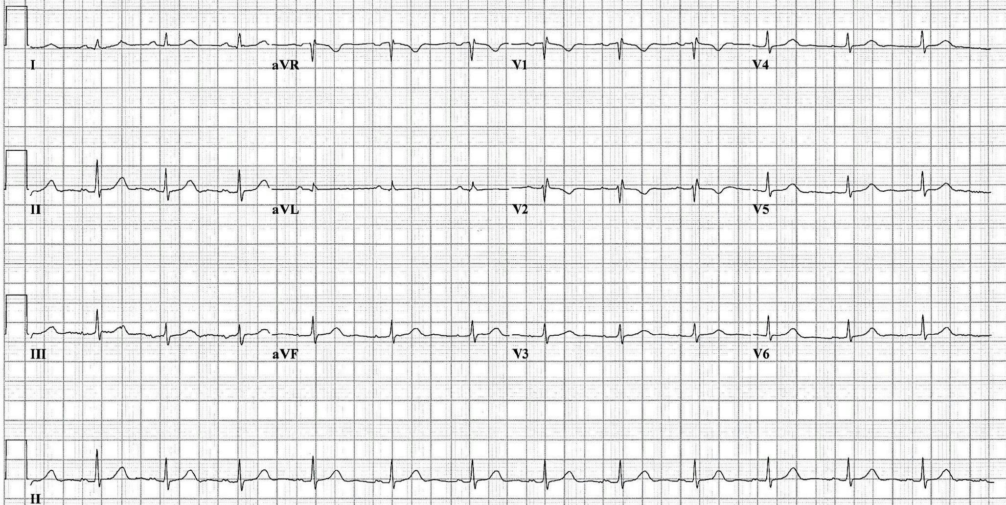 EKG of a patient