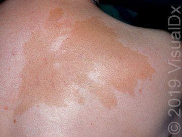 Image IQ:  A 6-year-old girl with brown patches on her trunk