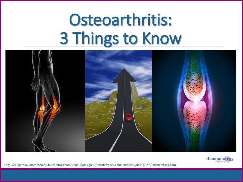 Osteoarthritis: 3 Things to Know