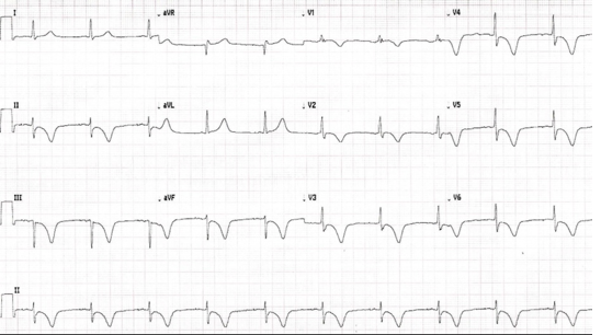 Computer Read: Atrial pacemaker at 60 bpm, marked LAD, ST deviation and T-wave abnormalities consider inferior and anterolateral ischemia.
