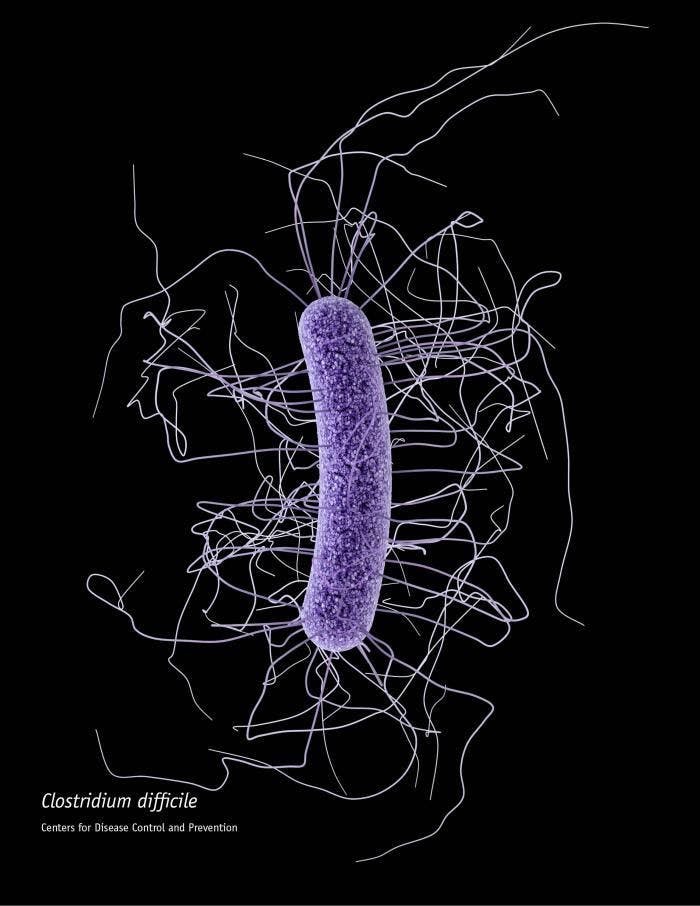 C difficile Infections Increasing, Becoming More Difficult to Treat