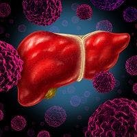 carcinoma, HCV, hepatitis c, liver cancer