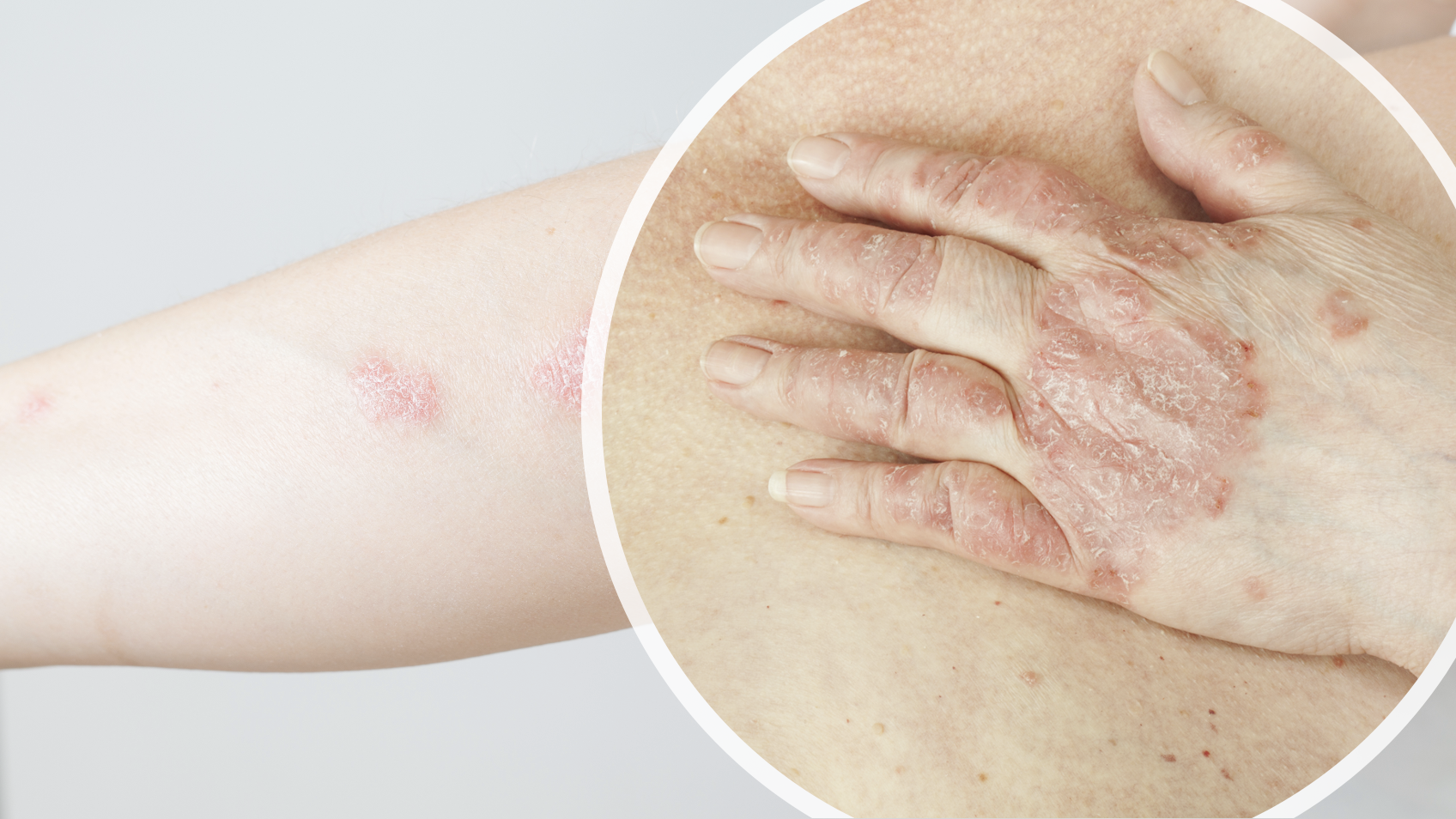 Multidomain Disease More Common, Linked to Worse Outcomes in Psoriatic Arthritis 