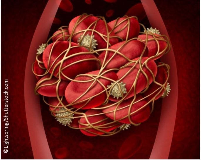 From 87th EAS: High Lipoprotein(a) Levels not Linked to Increased Prothrombotic Effects