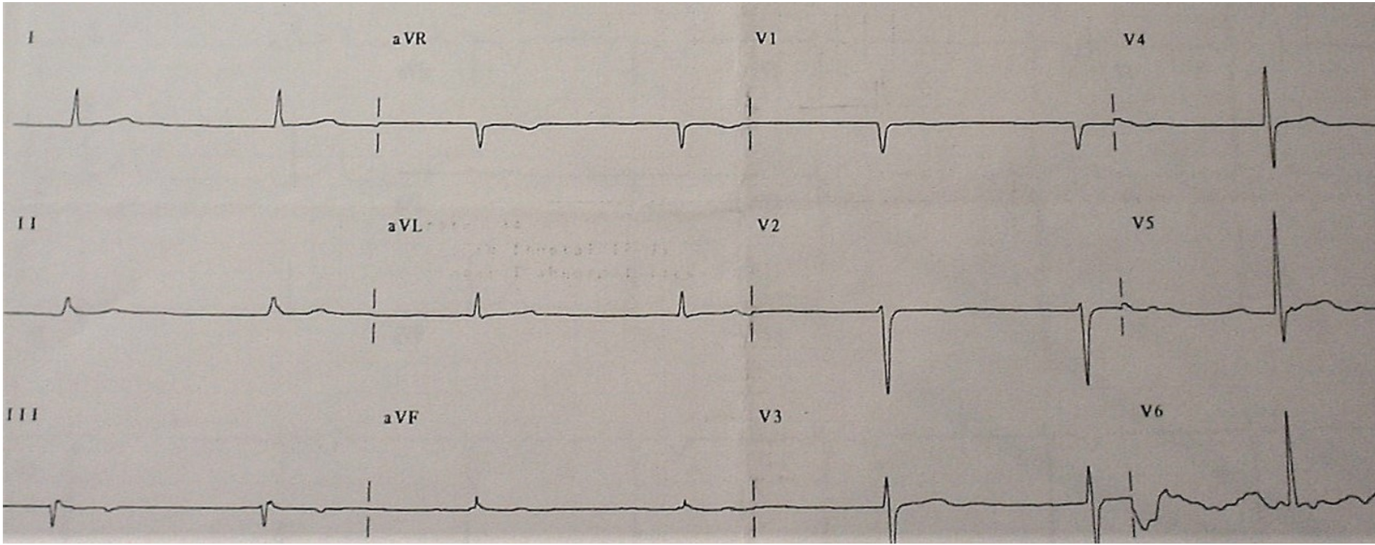 Cardiology Case Report: Syncope and Bradycardia