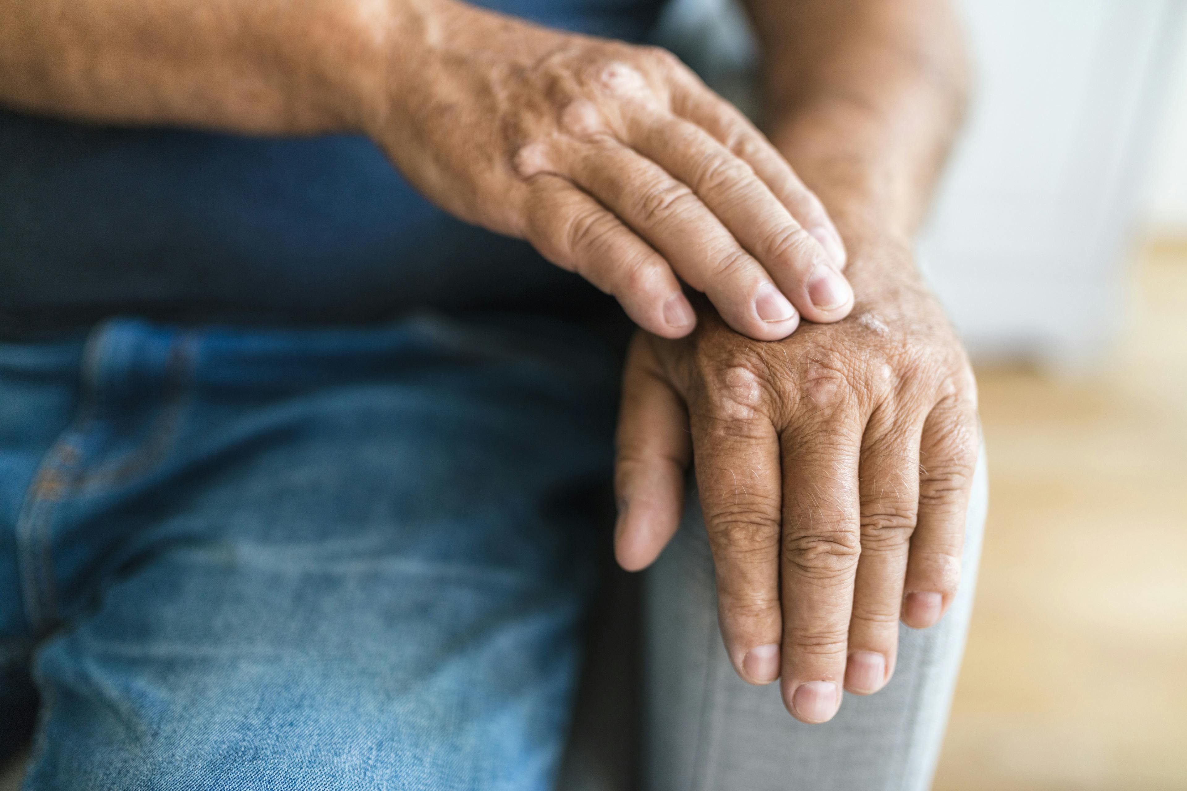 Q&A: Achieving Minimal Disease Activity in Patients with Recent-Onset Psoriatic Arthritis