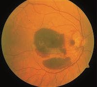 Intraviteral Ranibizumab Effective Treatment for AMD with Submacular Hemorrhage