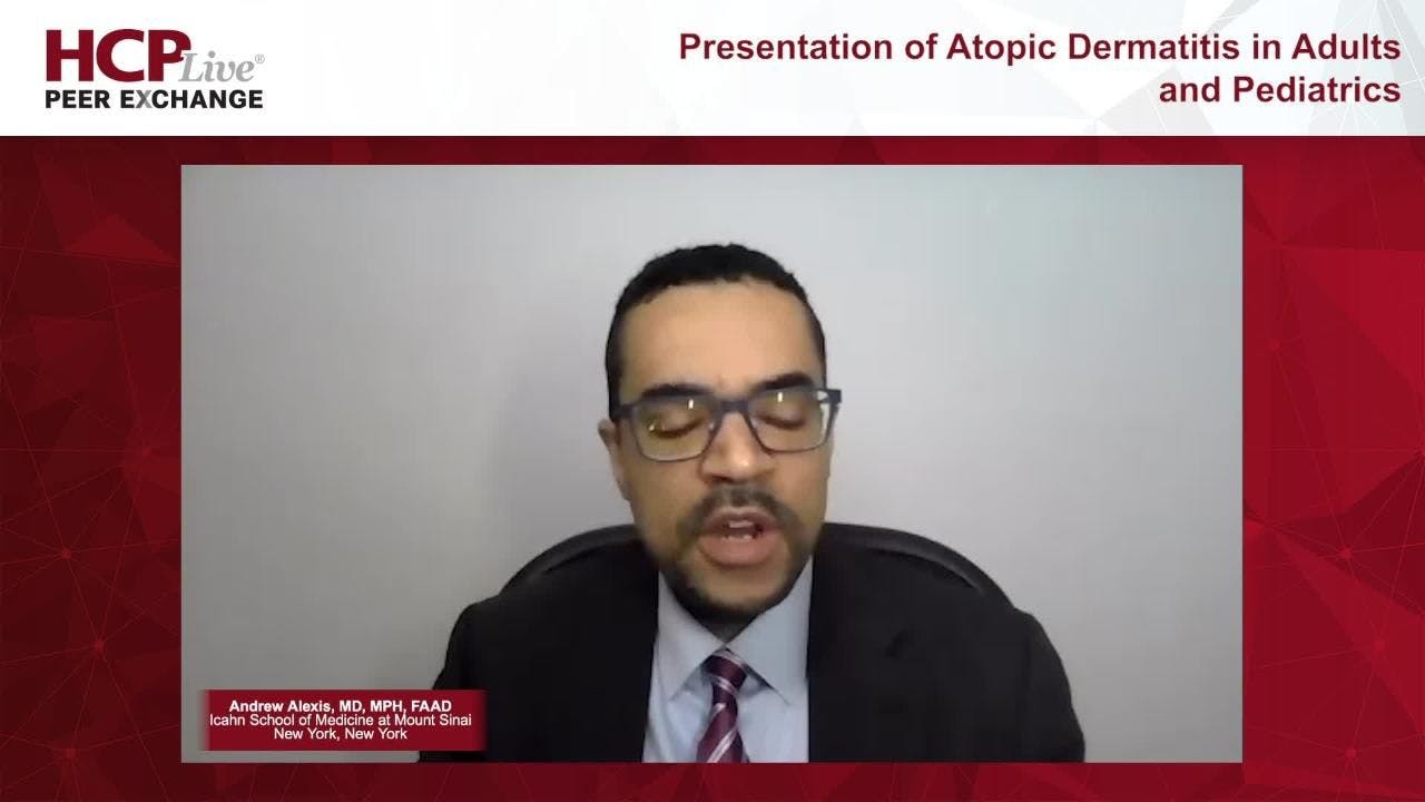 Presentation of Atopic Dermatitis in Adults and Pediatrics