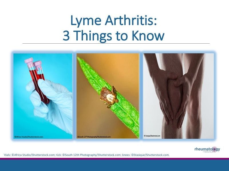 Lyme Arthritis: 3 Things to Know