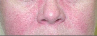Heliotrope rash of dermatomyositis.