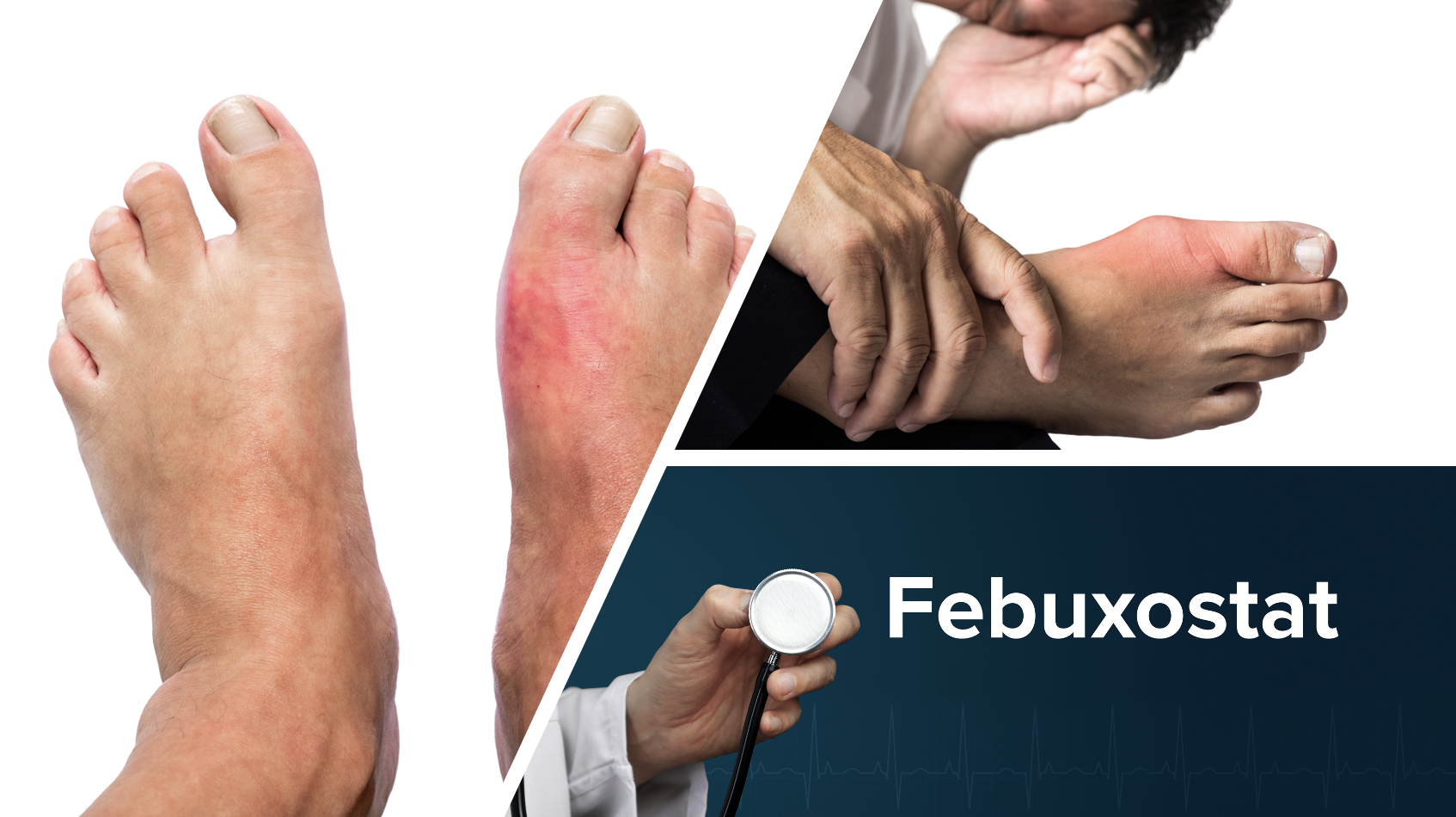 Initiation of Febuxostat Does Not Prolong Acute Gout Flares