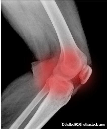 Knee osteoarthritis pain x-ray