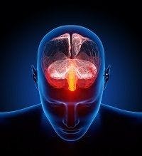  Myelination Problems Linked to Migraines