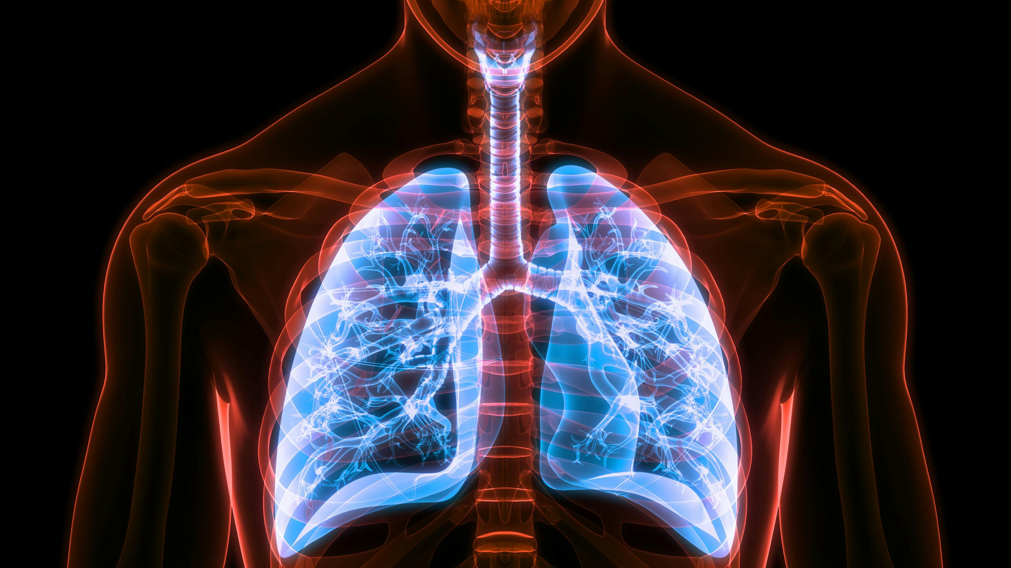 Pirfenidone Slows Decline of Forced Vital Capacity in RA-Associated Interstitial Lung Disease 