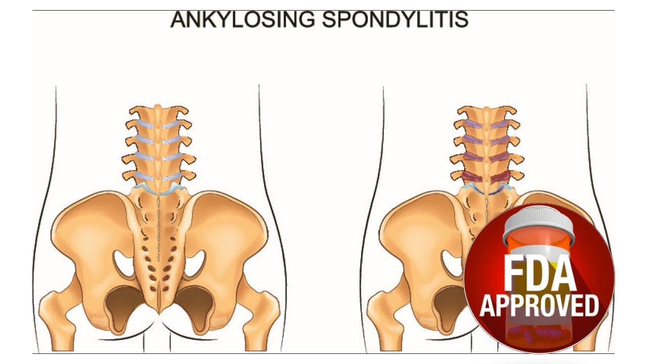 FDA Approves Ixekizumab for Ankylosing Spondylitis
