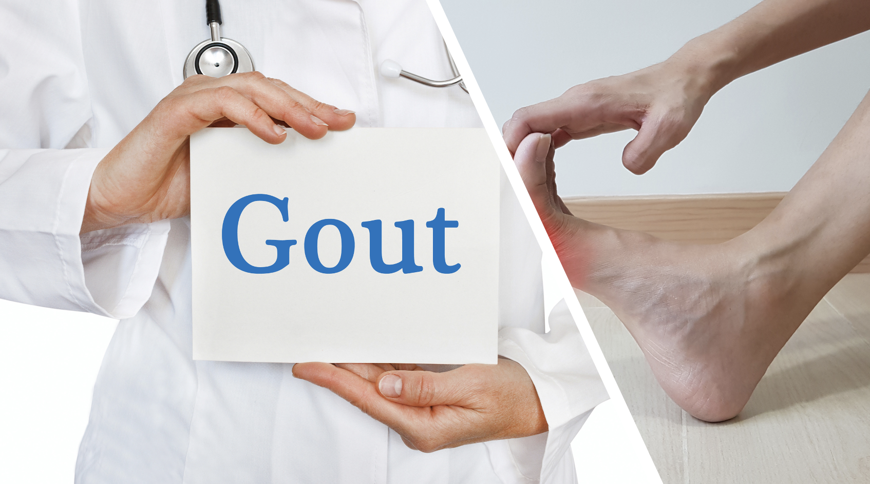 Anakinra Proves to Be an Effective Alternative Treatment for Gout Flares