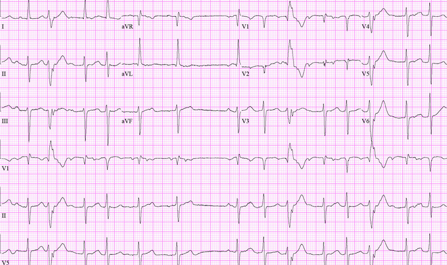 ECG computer print out of atrial fibrillation in an older women